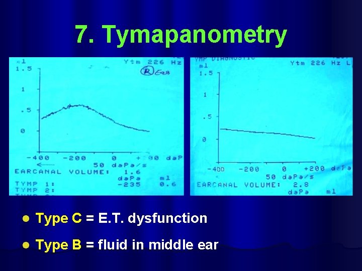 7. Tymapanometry l Type C = E. T. dysfunction l Type B = fluid
