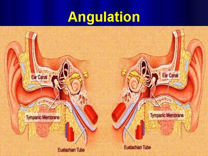Angulation 