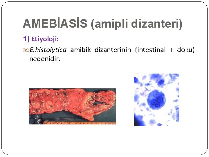 AMEBİASİS (amipli dizanteri) 1) Etiyoloji: E. histolytica amibik dizanterinin (intestinal + doku) nedenidir. 