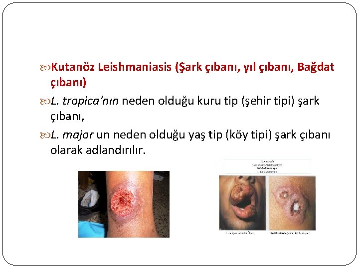 Kutanöz Leishmaniasis (Şark çıbanı, yıl çıbanı, Bağdat çıbanı) L. tropica'nın neden olduğu kuru