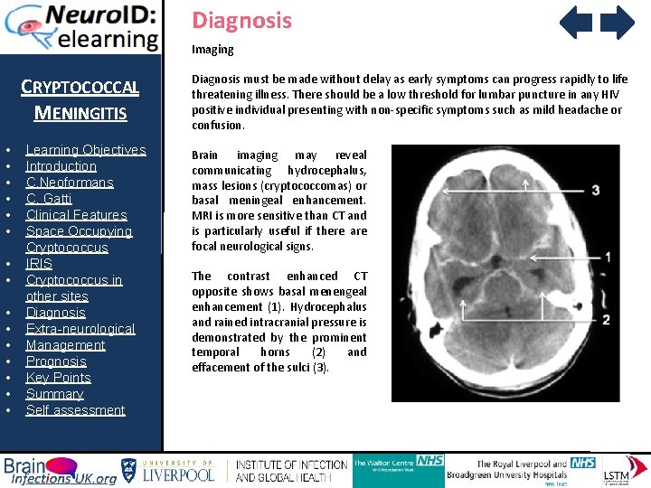 Diagnosis Imaging CRYPTOCOCCAL MENINGITIS • • • • Learning Objectives Introduction C. Neoformans C.