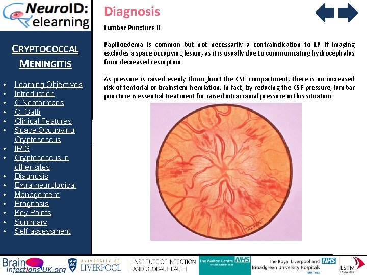 Diagnosis Lumbar Puncture II CRYPTOCOCCAL MENINGITIS • • • • Learning Objectives Introduction C.
