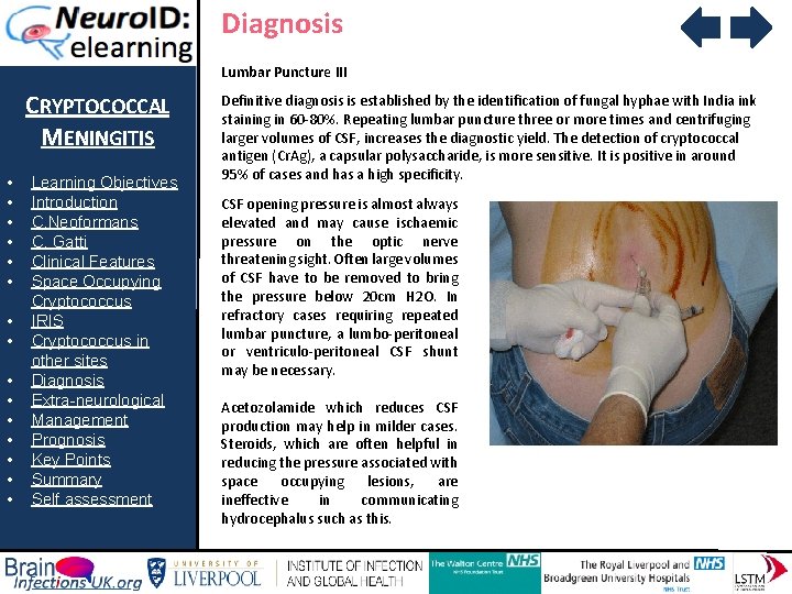 Diagnosis Lumbar Puncture III CRYPTOCOCCAL MENINGITIS • • • • Learning Objectives Introduction C.