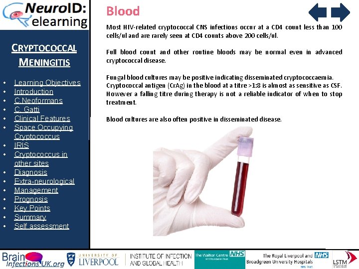 Blood Most HIV-related cryptococcal CNS infections occur at a CD 4 count less than