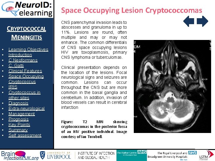 Space Occupying Lesion Cryptococcomas CRYPTOCOCCAL MENINGITIS • • • • Learning Objectives Introduction C.