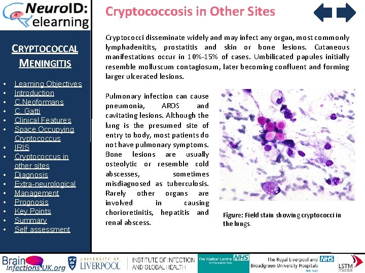Cryptococcosis in Other Sites CRYPTOCOCCAL MENINGITIS • • • • Learning Objectives Introduction C.