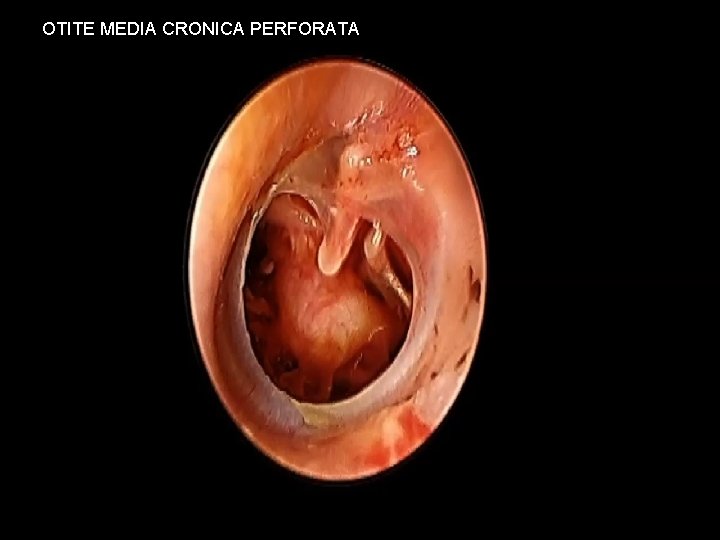 OTITE MEDIA CRONICA PERFORATA 