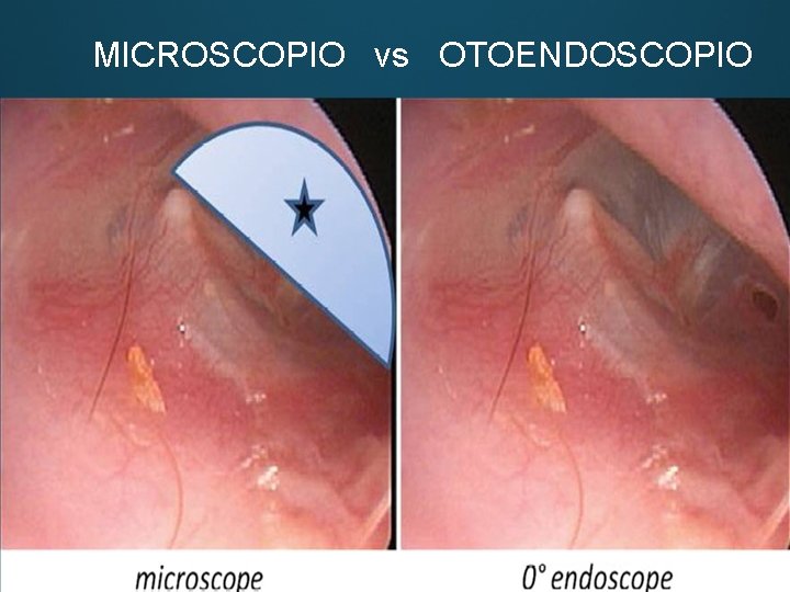 MICROSCOPIO vs OTOENDOSCOPIO 