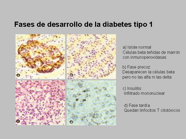 Fases de desarrollo de la diabetes tipo 1 a) Islote normal Células beta teñidas