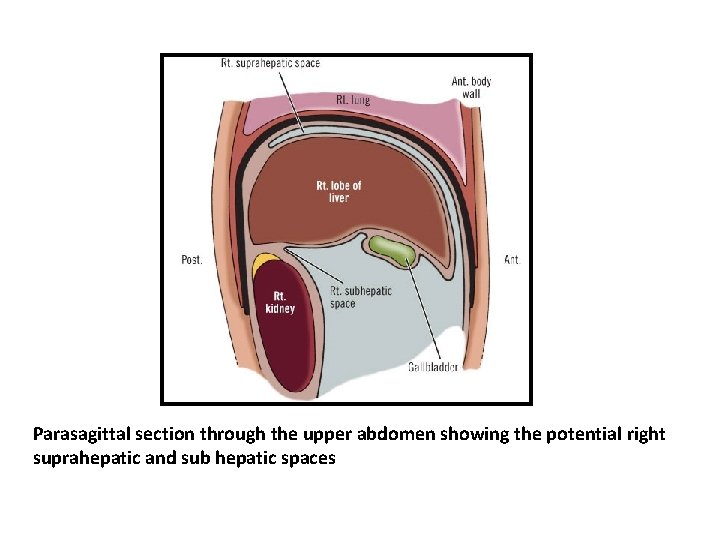 Parasagittal section through the upper abdomen showing the potential right suprahepatic and sub hepatic Parasagittal section through the upper abdomen showing the potential right suprahepatic and sub hepatic