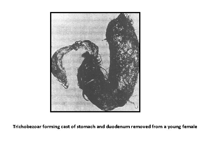 Trichobezoar forming cast of stomach and duodenum removed from a young female 