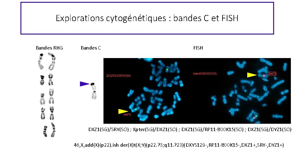 Explorations cytogénétiques : bandes C et FISH Bandes RHG Bandes C FISH DXZ 1(SG)/SRY(SO)