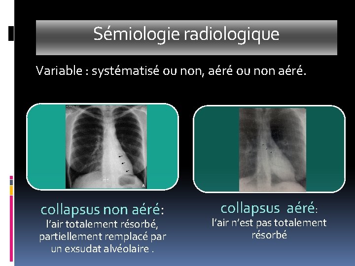 Sémiologie radiologique Variable : systématisé ou non, aéré ou non aéré. collapsus non aéré: Sémiologie radiologique Variable : systématisé ou non, aéré ou non aéré. collapsus non aéré:
