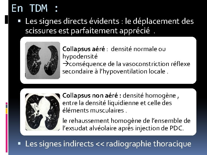 En TDM : Les signes directs évidents : le déplacement des scissures est parfaitement En TDM : Les signes directs évidents : le déplacement des scissures est parfaitement