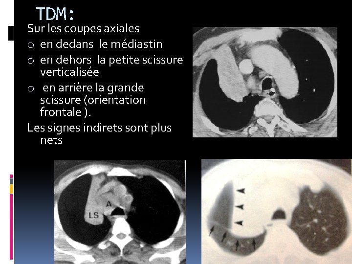 TDM: Sur les coupes axiales o en dedans le médiastin o en dehors la