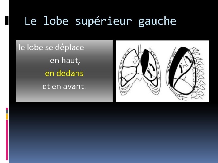 Le lobe supérieur gauche le lobe se déplace en haut, en dedans et en Le lobe supérieur gauche le lobe se déplace en haut, en dedans et en