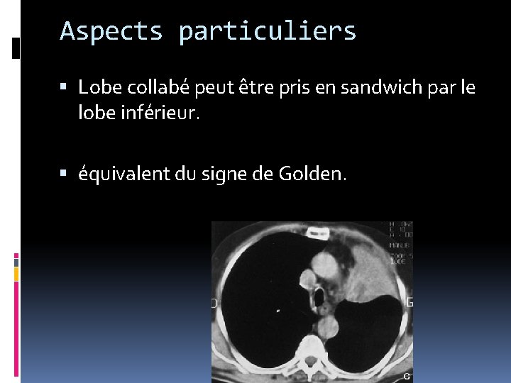 Aspects particuliers Lobe collabé peut être pris en sandwich par le lobe inférieur. équivalent