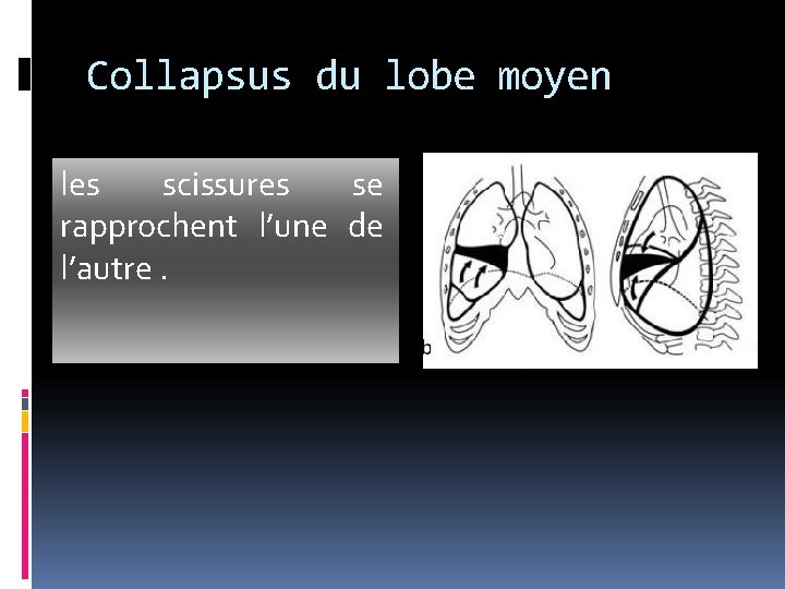 Collapsus du lobe moyen les scissures se rapprochent l’une de l’autre. Collapsus du lobe moyen les scissures se rapprochent l’une de l’autre.