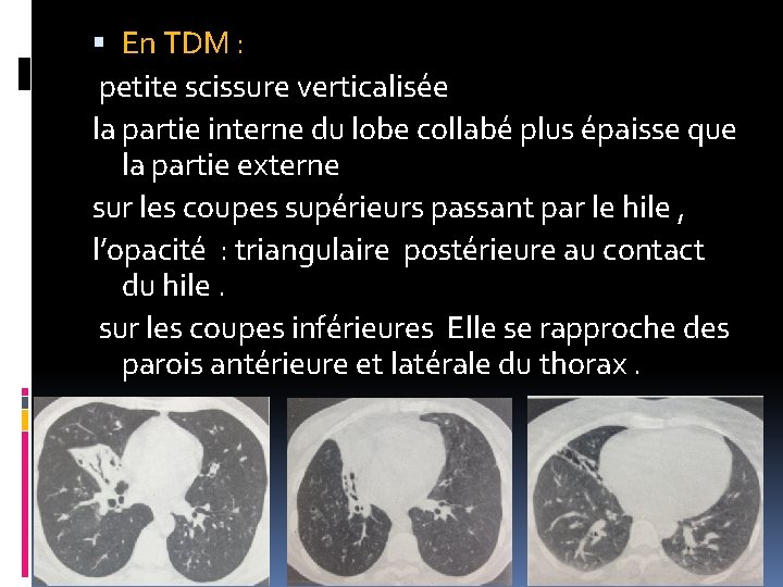  En TDM : petite scissure verticalisée la partie interne du lobe collabé plus