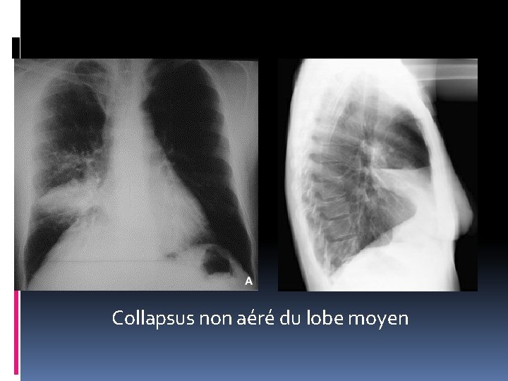 Collapsus non aéré du lobe moyen 