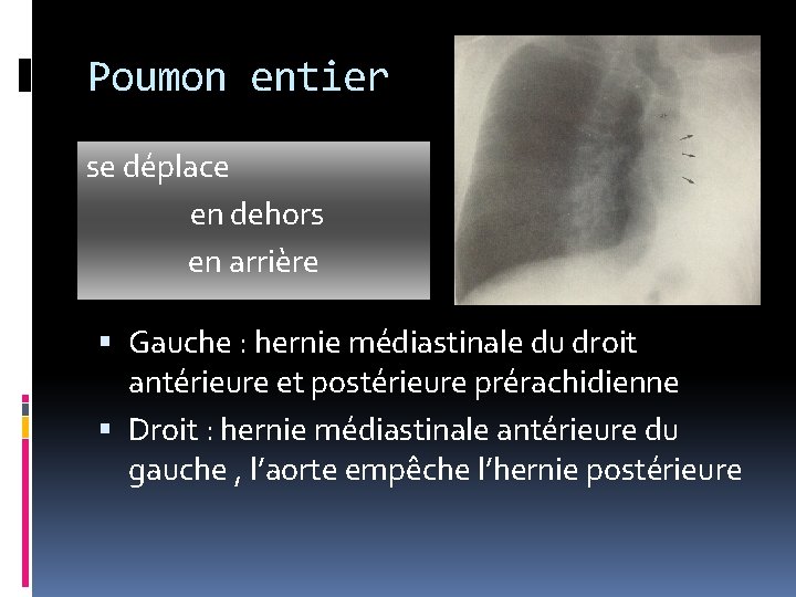 Poumon entier se déplace en dehors en arrière Gauche : hernie médiastinale du droit