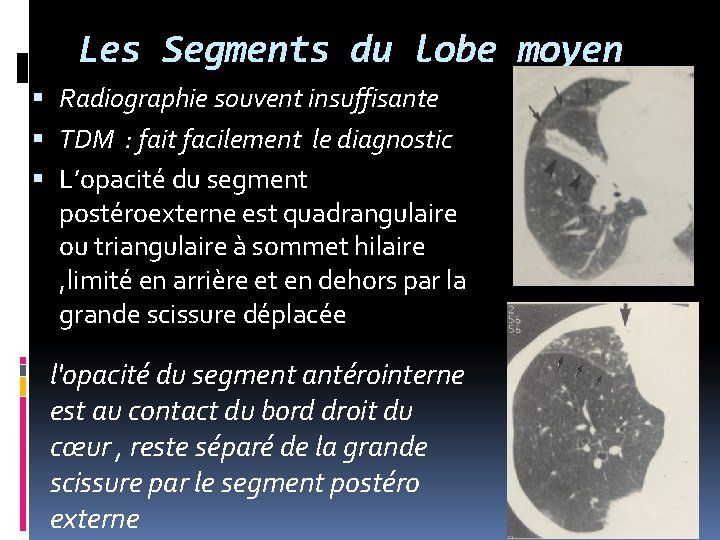 Les Segments du lobe moyen Radiographie souvent insuffisante TDM : fait facilement le diagnostic