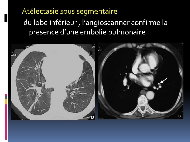 Atélectasie sous segmentaire du lobe inférieur , l’angioscanner confirme la présence d’une embolie pulmonaire