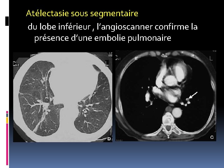 Atélectasie sous segmentaire du lobe inférieur , l’angioscanner confirme la présence d’une embolie pulmonaire Atélectasie sous segmentaire du lobe inférieur , l’angioscanner confirme la présence d’une embolie pulmonaire