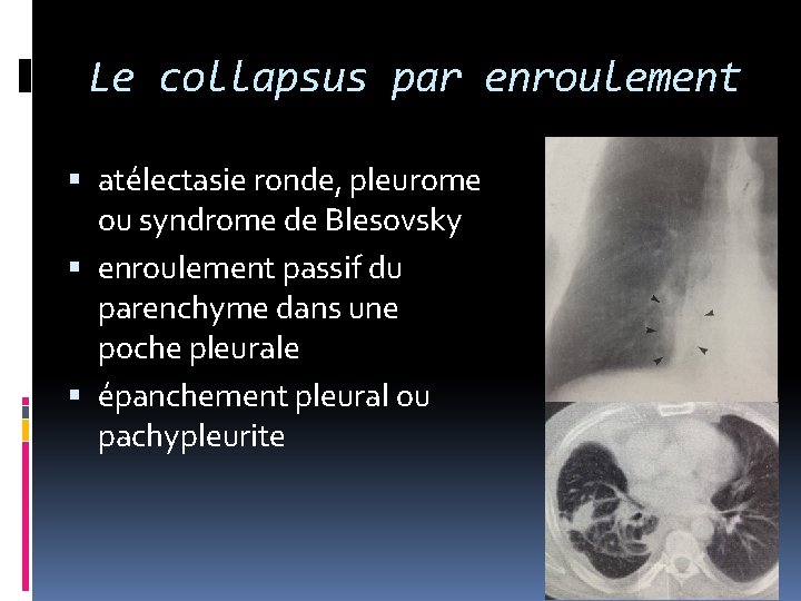 Le collapsus par enroulement atélectasie ronde, pleurome ou syndrome de Blesovsky enroulement passif du