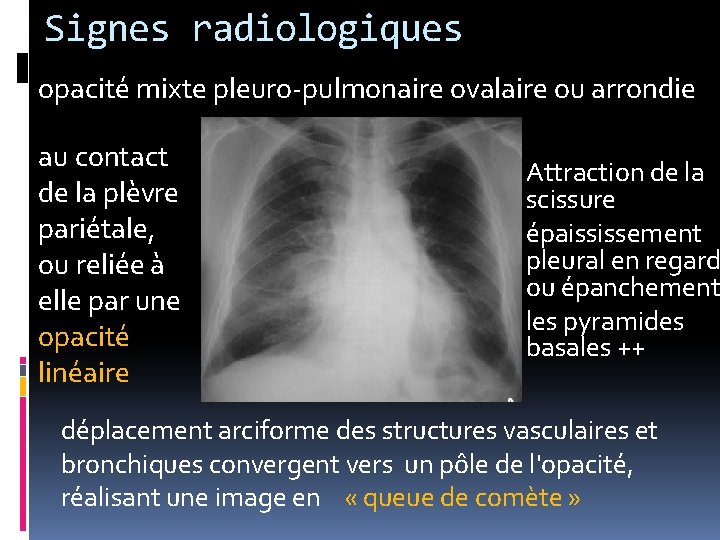 Signes radiologiques opacité mixte pleuro-pulmonaire ovalaire ou arrondie au contact de la plèvre pariétale,