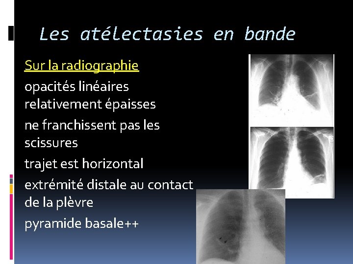 Les atélectasies en bande Sur la radiographie opacités linéaires relativement épaisses ne franchissent pas Les atélectasies en bande Sur la radiographie opacités linéaires relativement épaisses ne franchissent pas