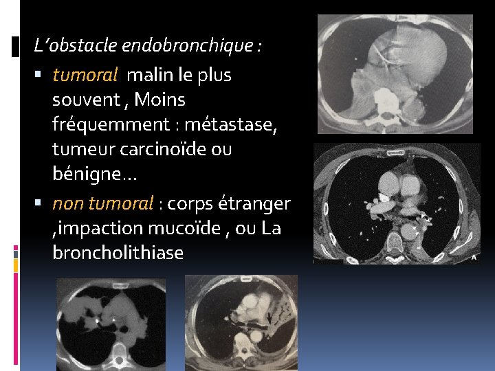 L’obstacle endobronchique : tumoral malin le plus souvent , Moins fréquemment : métastase, tumeur L’obstacle endobronchique : tumoral malin le plus souvent , Moins fréquemment : métastase, tumeur