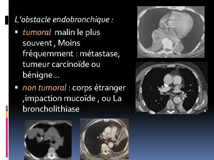 L’obstacle endobronchique : tumoral malin le plus souvent , Moins fréquemment : métastase, tumeur