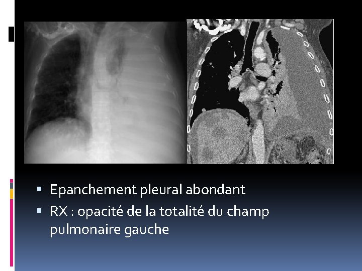  Epanchement pleural abondant RX : opacité de la totalité du champ pulmonaire gauche