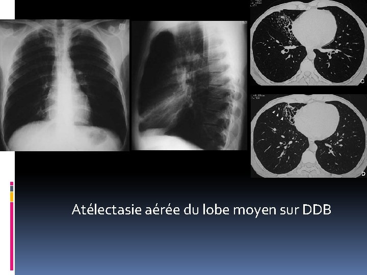 Atélectasie aérée du lobe moyen sur DDB 