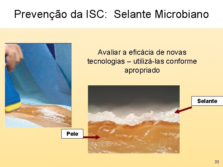 Prevenção da ISC: Selante Microbiano Avaliar a eficácia de novas tecnologias – utilizá-las conforme