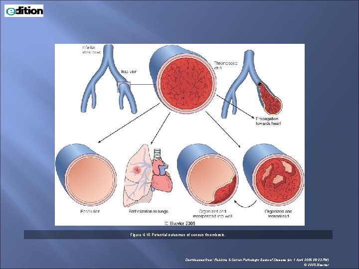 Figure 4 -15 Potential outcomes of venous thrombosis. Downloaded from: Robbins & Cotran Pathologic