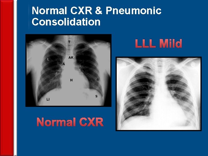 Normal CXR & Pneumonic Consolidation LLL Mild Normal CXR 60 