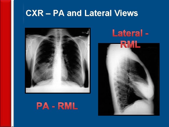 CXR – PA and Lateral Views Lateral RML PA - RML 62 