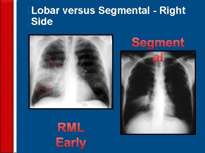 Lobar versus Segmental - Right Side Segment al 63 RML Early 