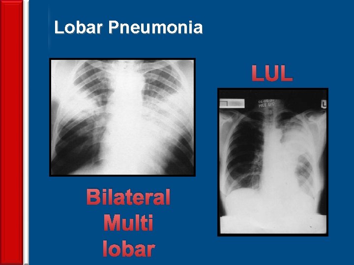 Lobar Pneumonia LUL 64 Bilateral Multi lobar 