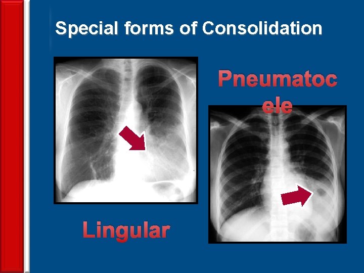 Special forms of Consolidation Pneumatoc ele Lingular 65 