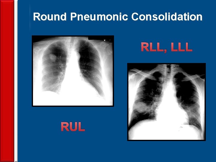 Round Pneumonic Consolidation RLL, LLL RUL 66 