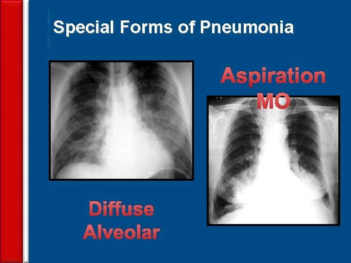 Special Forms of Pneumonia Aspiration MO Diffuse Alveolar 67 