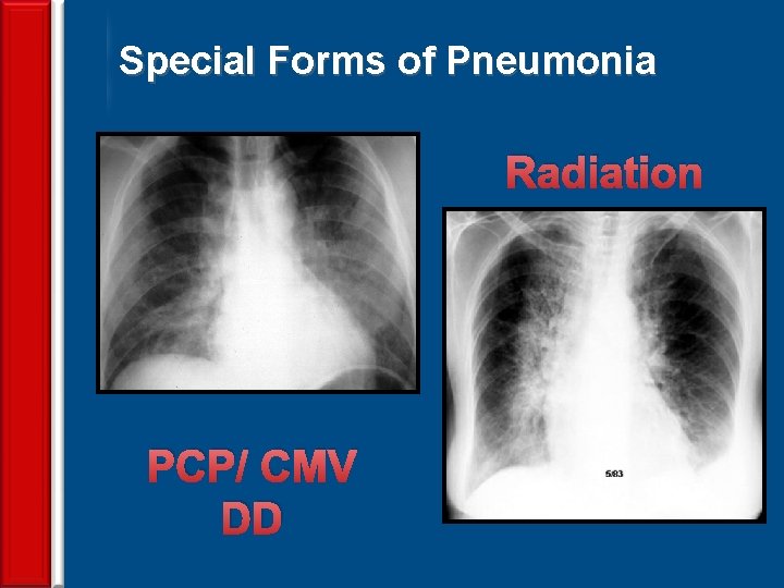 Special Forms of Pneumonia Radiation PCP/ CMV DD 68 