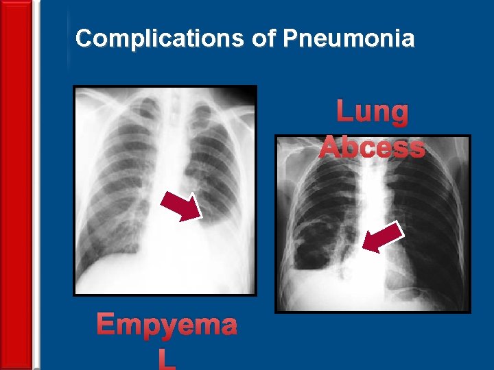 Complications of Pneumonia Lung Abcess 69 Empyema L 