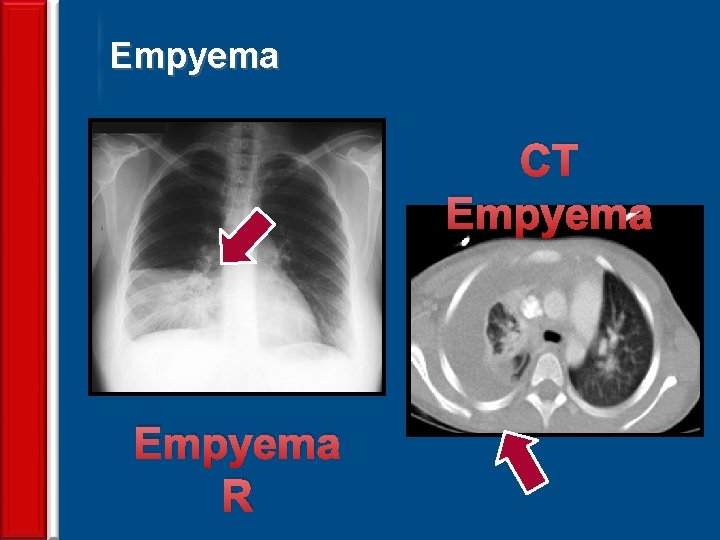 Empyema CT Empyema 70 Empyema R 