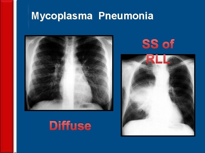 Mycoplasma Pneumonia SS of RLL Diffuse 71 