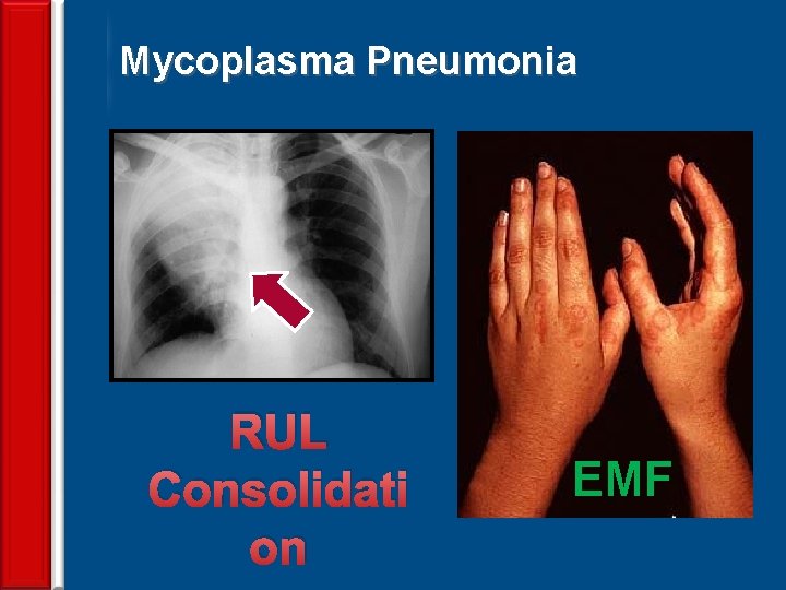Mycoplasma Pneumonia 72 RUL Consolidati on EMF 