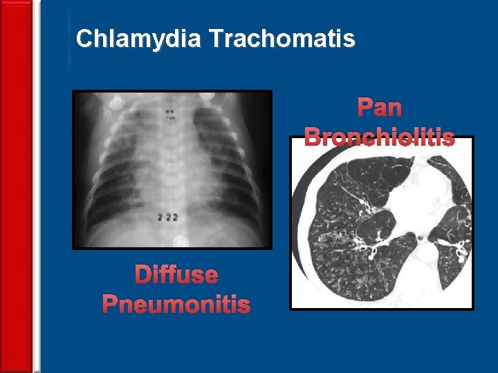 Chlamydia Trachomatis Pan Bronchiolitis Diffuse Pneumonitis 73 